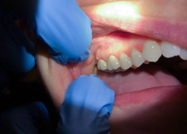 Best Emergency Root Canal Treatment in Longview, TX